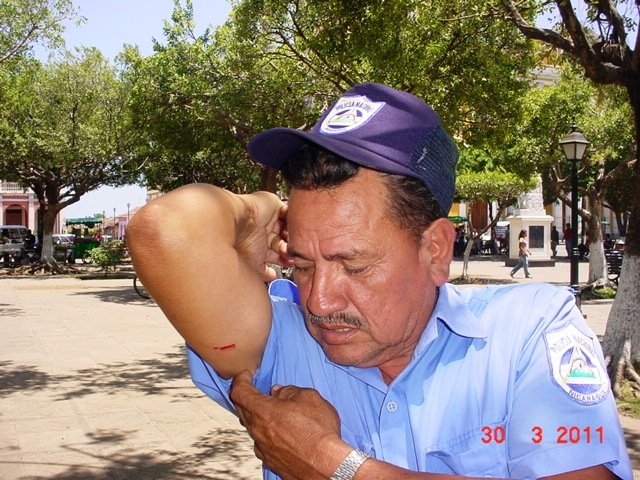 Luis Lacayo muestra la lesion que le hizo un bolo en el Parque Central Colon